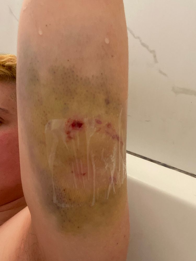 Sitting in the bath with my left arm up showing the aftermath of a dog bite I got 3 days ago on my tricep. It’s very bruised purple yellow and green with bloody teeth marks
