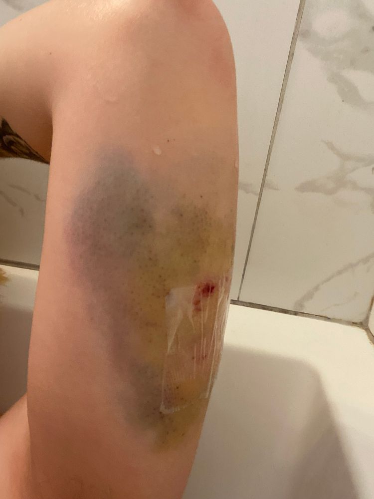 Sitting in the bath with my left arm up showing the aftermath of a dog bite I got 3 days ago on my tricep. It’s very bruised purple yellow and green with bloody teeth marks shows the more inward bruising towards my bicep 