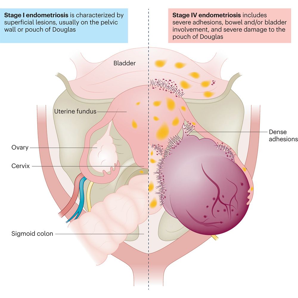 This is figure 1, which shows endometriosis staging.