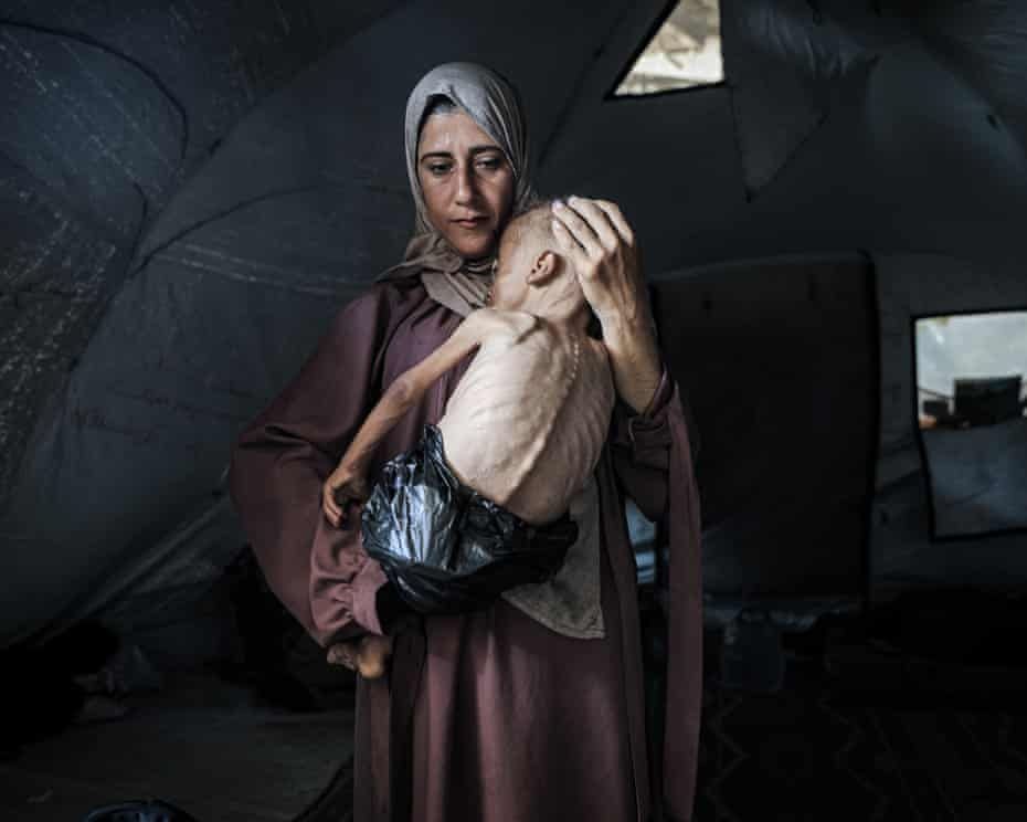 A one-and-a-half-year-old child in Gaza facing life-threatening malnutrition as the humanitarian situation worsens due to ongoing Israeli attacks and blockade.

Photograph: Anadolu/Getty Images, via The Guardian