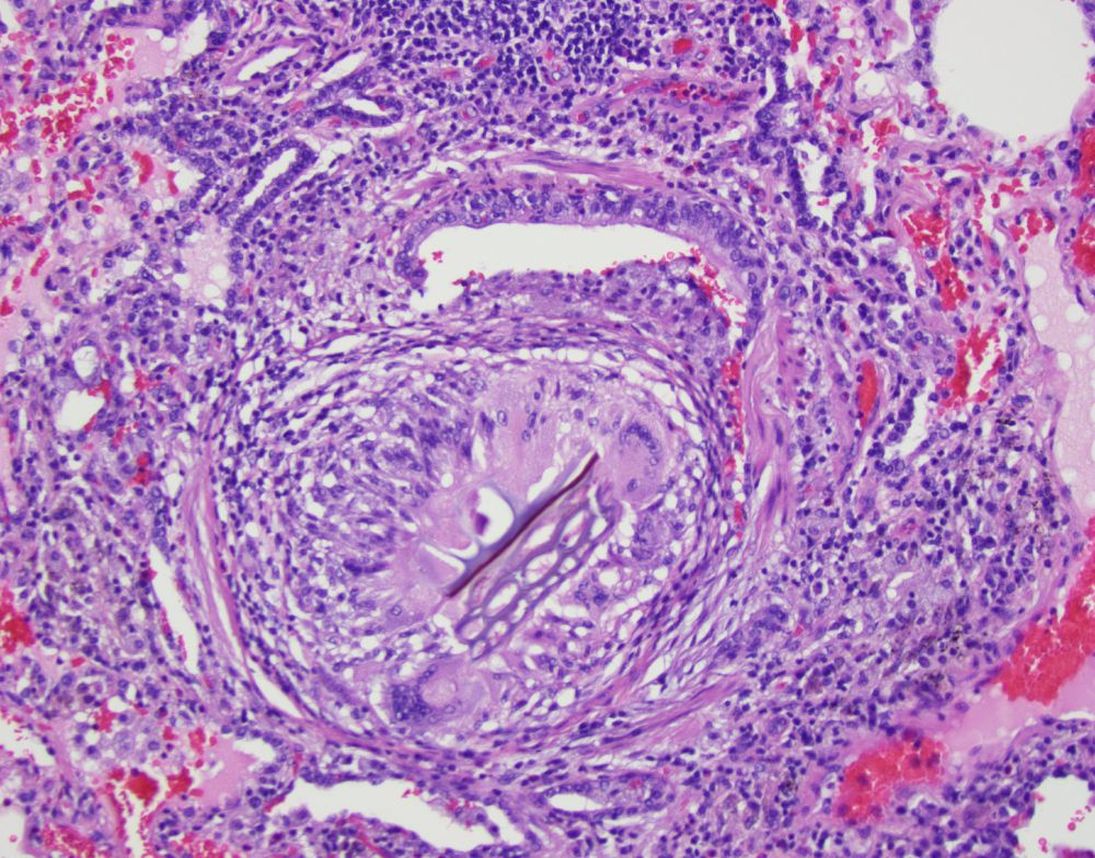 Intermediate magnification photomicrograph of H&E slide of lung with a peribronchioloar non-necrotizing granuloma with plant material in the center.