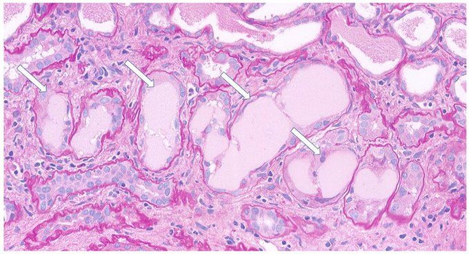 Figure 1. Renal histology. Sharp-edged PAS-negative casts (arrows) in tubular lumen (periodic acid-Schiff stain, original magnification ×400).