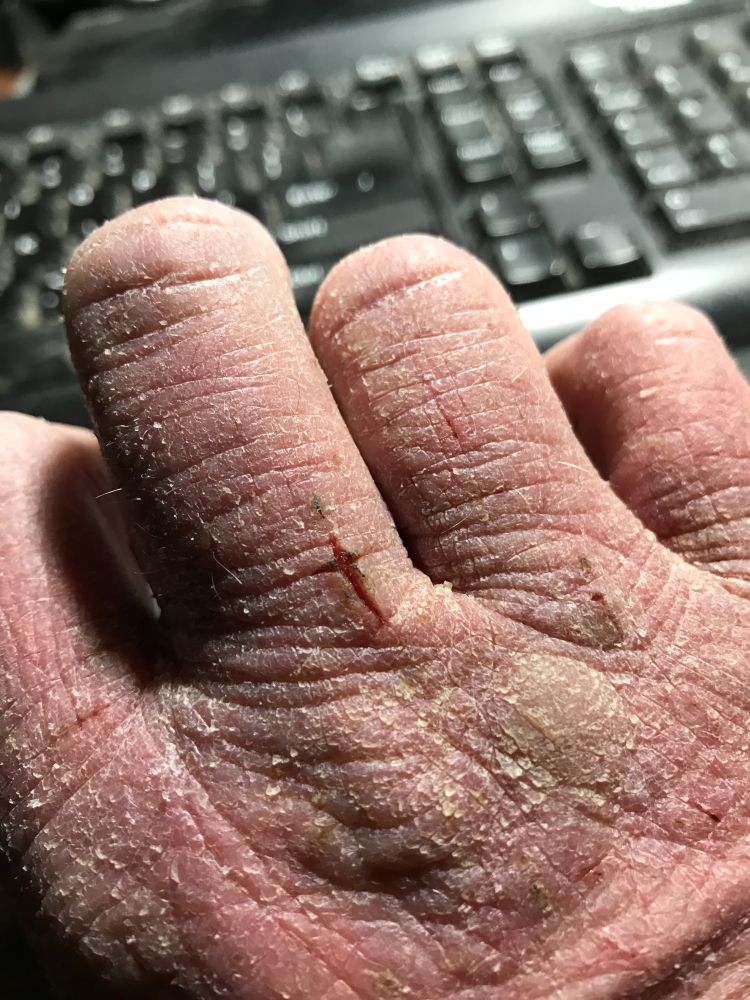 My fucked up hand, complete with dry skin and fissures.