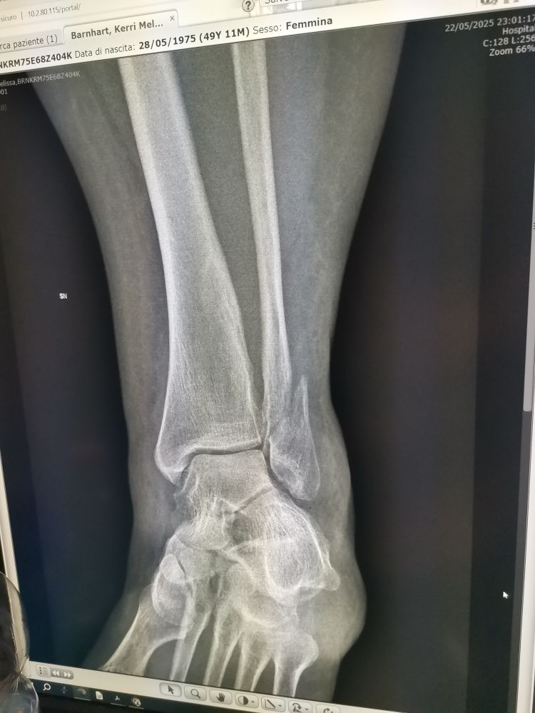 X-ray of an obviousky broken ankle 