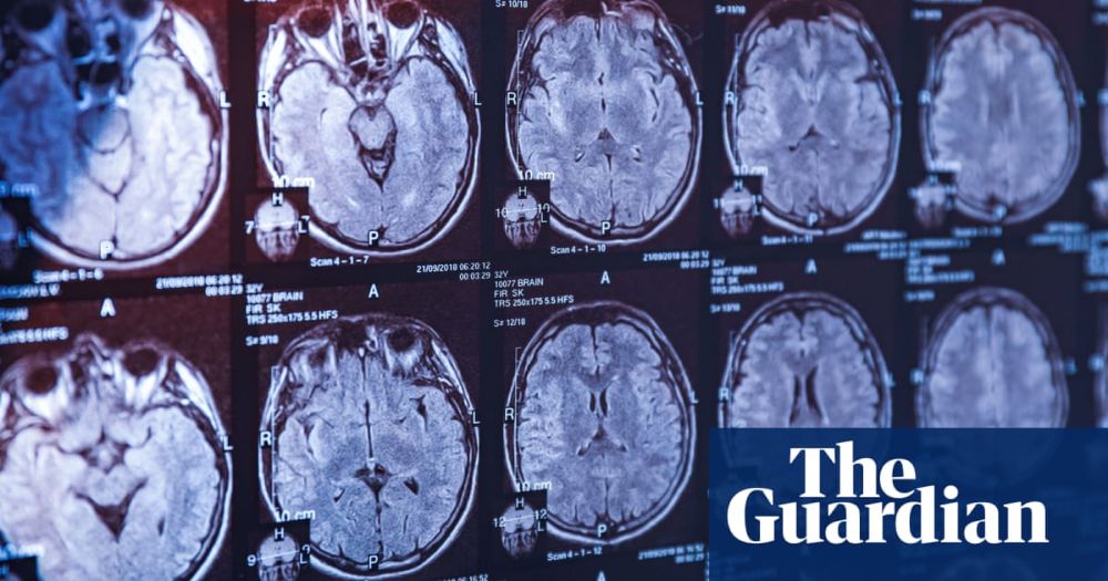 UK health regulator rejects lecanemab as treatment for Alzheimer’s