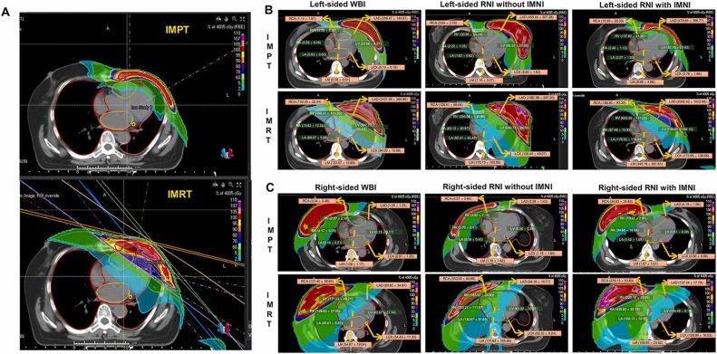 From Fig. 1. The irradiation field diagrams of IMPT and IMRT (A) and illustration of cardiac substructures delineation, mean dose, and isodose line distribution for IMPT and IMRT in left-sided (B) and right-sided (C) patients. Note: The mean dose to cardiac substructures is measured in cGy(RBE). 