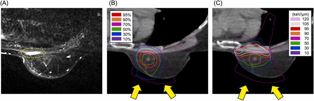 Fig. 1. A pectoral myositis and dose distributions of C-ion RT.