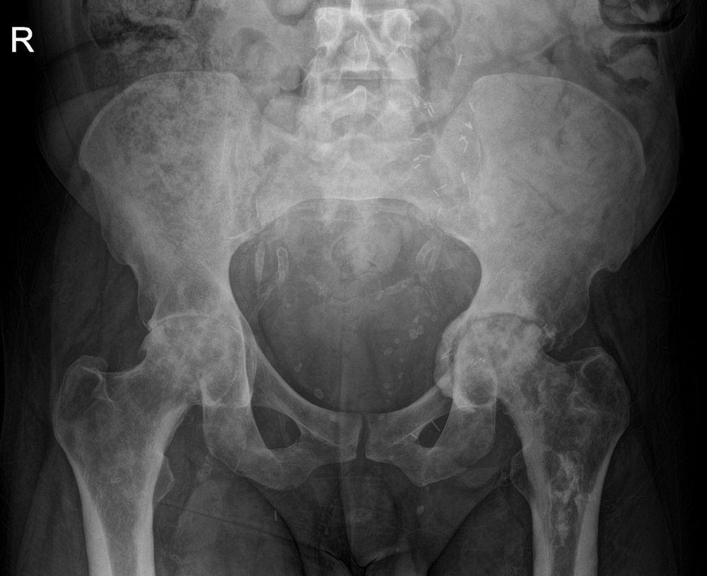 X-ray of the pelvis