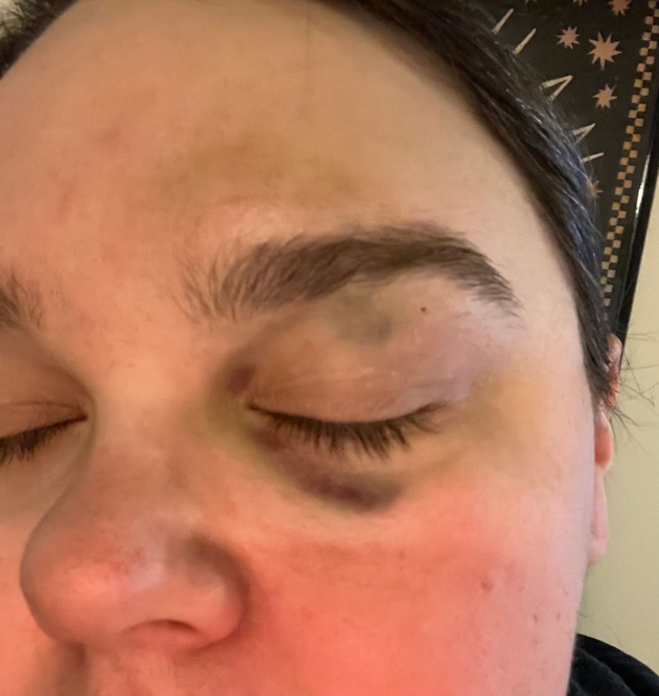 selfie pic of me facing the camera showing initial black eye, day 3