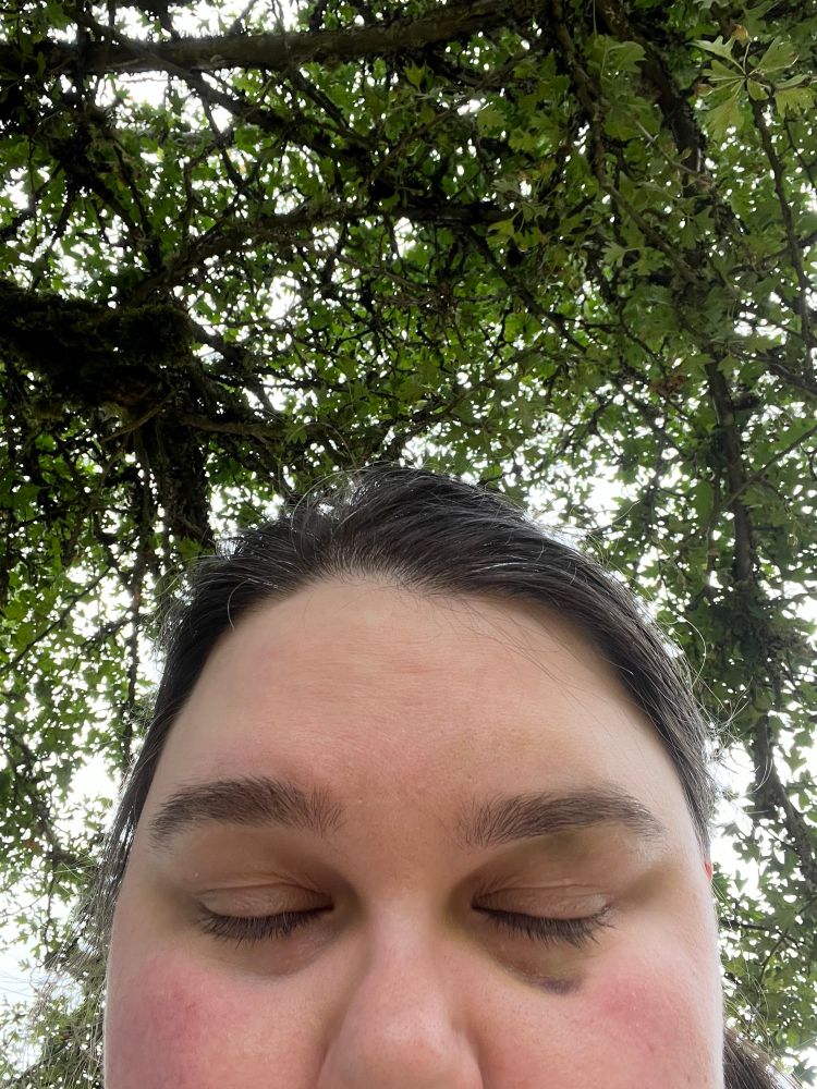 selfie pic of me facing the camera showing initial black eye, day 8, outdoors under a tree with both eyes closed 