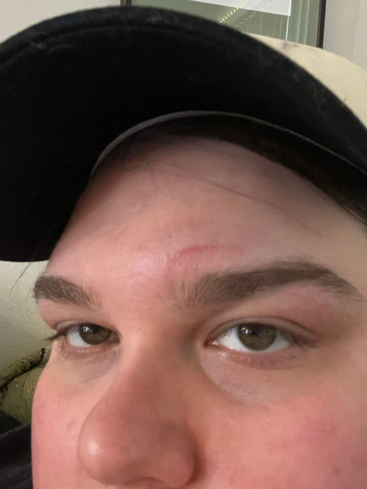 selfie pic of me facing the camera showing initial black eye, day 1 