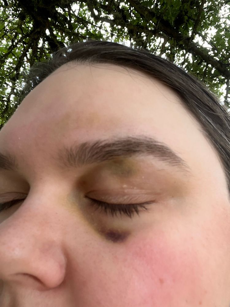 selfie pic of me facing the camera showing initial black eye, day 8 from a different perspective 