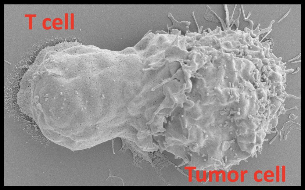 A scanning electron microscope image showing the T cell producing a thin sheet of plasma membrane that protrudes over the cancer cell. This membrane protrusion is regulated by the polymerzation and depolymerization of filamentous actin. Multiple receptors on the T cell are engaging their ligands on the tumor cell and transmitting biochemical signals into the T cell interior to enhance the interaction between itself and the tumor cell. In addition, the lytic granules (think of them as cell hand grenades) are moved by the microtubule system to contact site between the two cells. The lytic granules then fuse with the plasma membrane releasing the contents and killing the tumor cell.