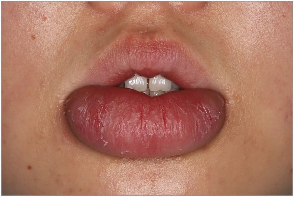 Granulomatous cheilitis
