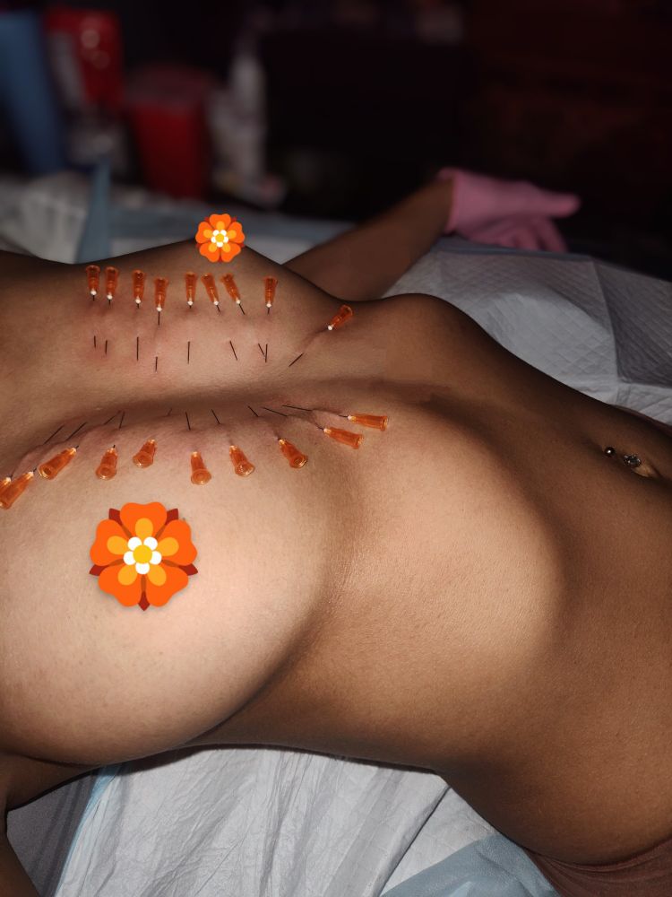 A picture of machina's torso while they are laying down with several orange needles pierced down their sternum. They are nude, with a visible belly button ring and 1 pink glove 