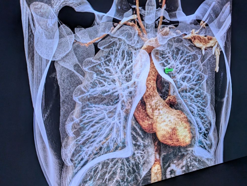 CT-datensatz eines brustkorbes mit cinematic rendering dargestellt