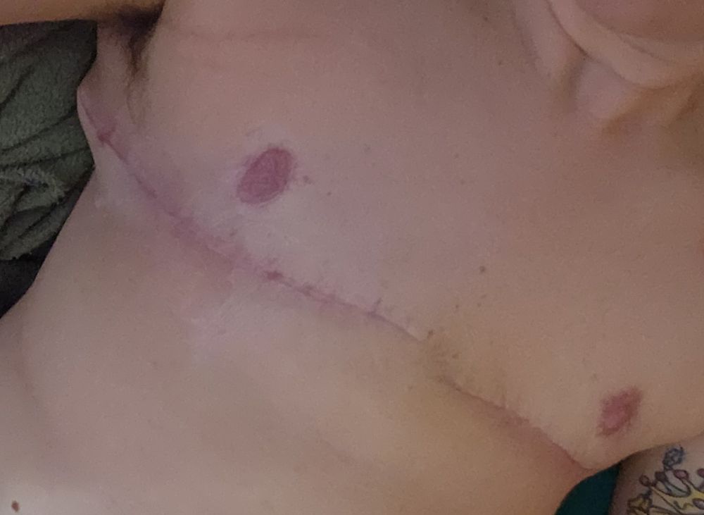 A pic of me laying down without a shirt on. You can see my top surgery scars and my nipples that are still healing. 