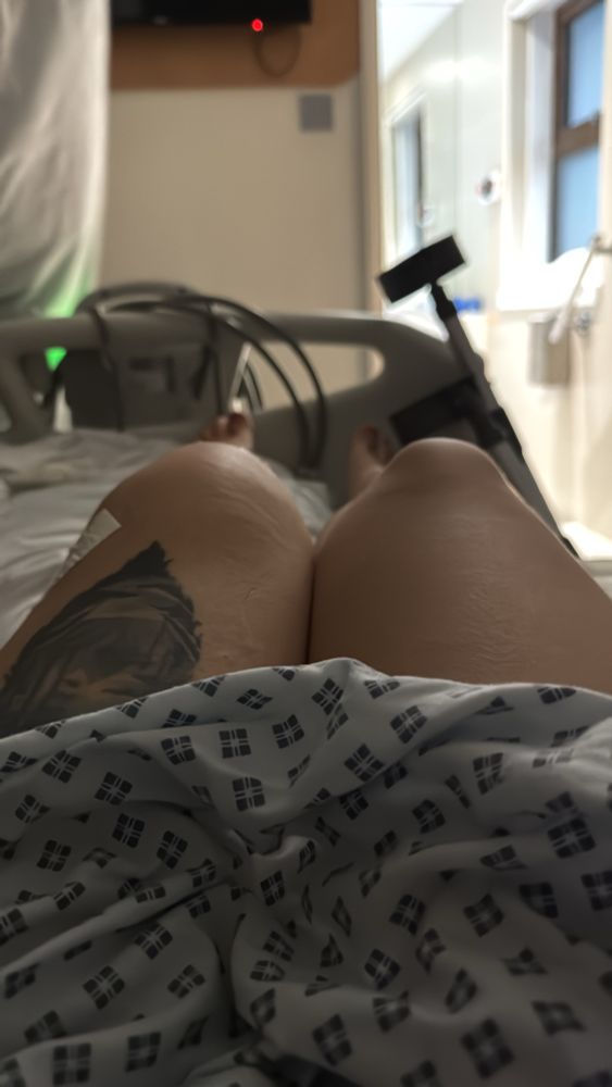 Normal knee vs Swollen knee following ACL reconstruction surgery