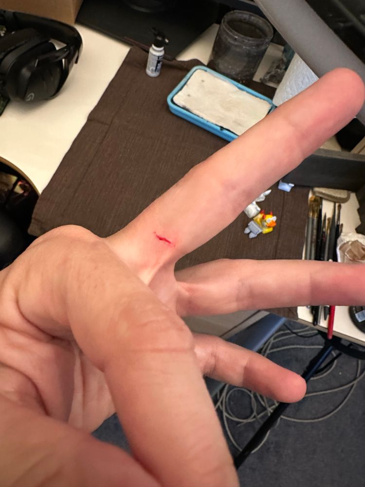 An accidental incision to the inside of the index finger just before the webbing starts on the next finger.  It doesn’t look bad from this angle but it is deep in in triangular point to the bone/tendon.