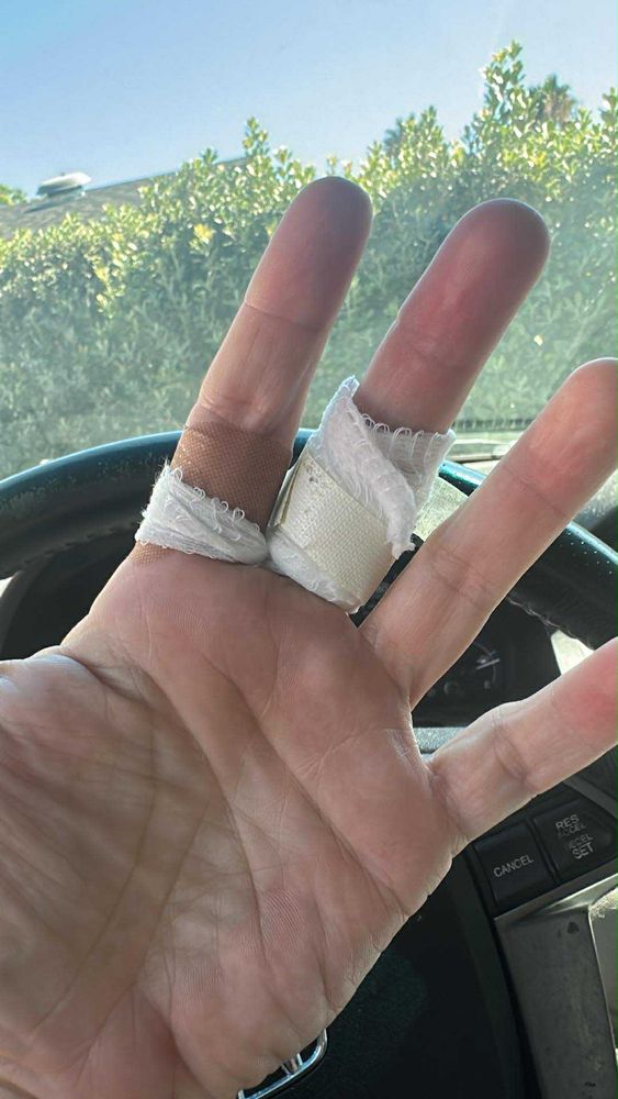 A hand being held up palm facing.  There is gauze and tape on the middle finger and an ‘assist’ tape on the index finger because this person was a DUMBASS