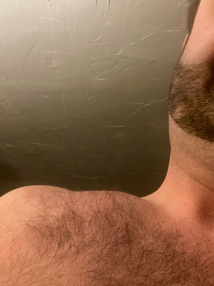 Pic of my right shoulder with a huge swollen welt 