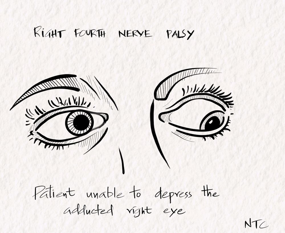 Schematic diagram showing right fourth cranial nerve palsy with patient unable to depress the adducted right eye on looking to the left and downwards.