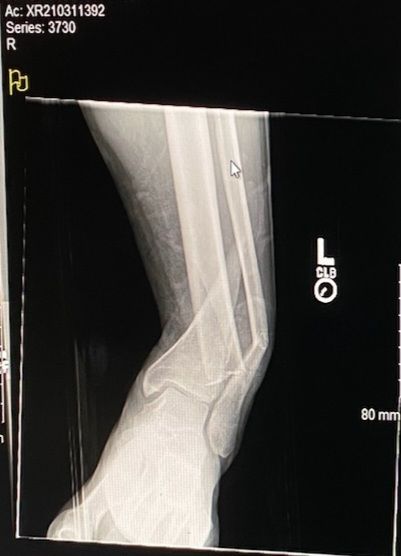 X-ray of broken Tibia and Fibula. 