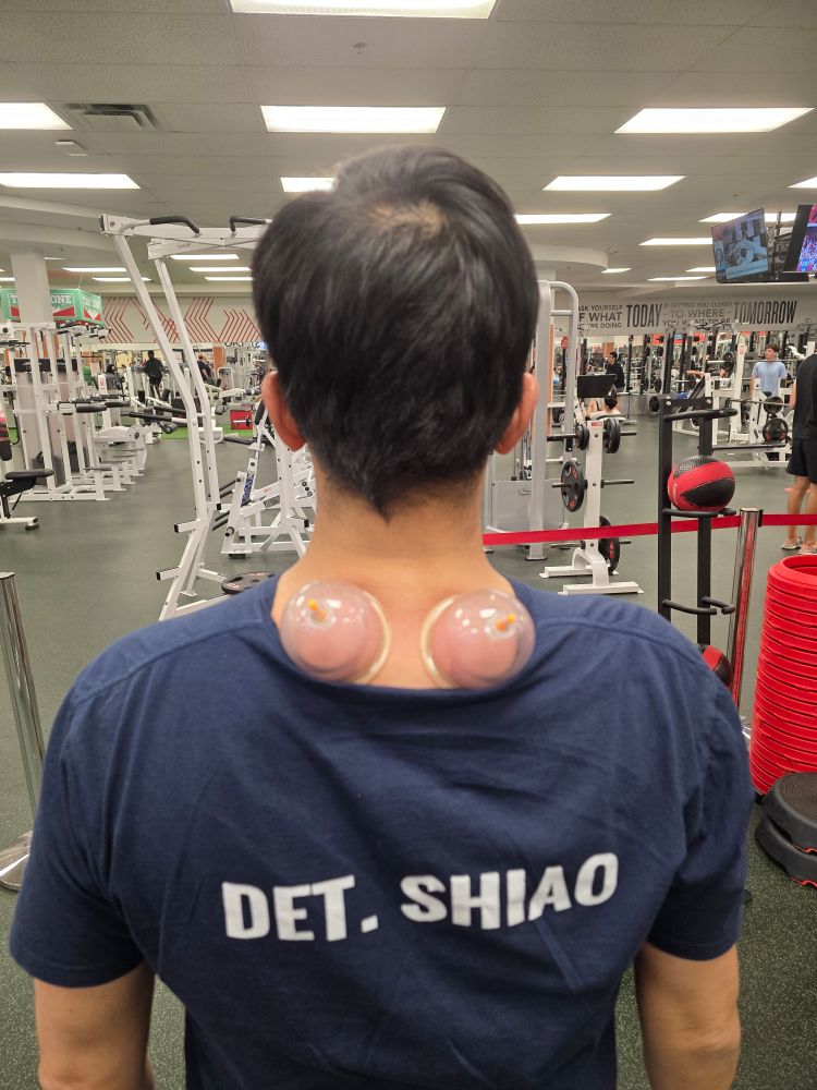 My trainer did cupping on my back.