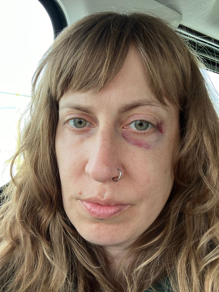 photo of me, left eye blackened and left side of face smashed in