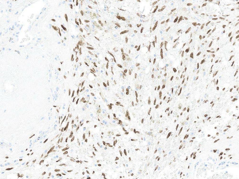 SS18::SSX fusion protein IHC