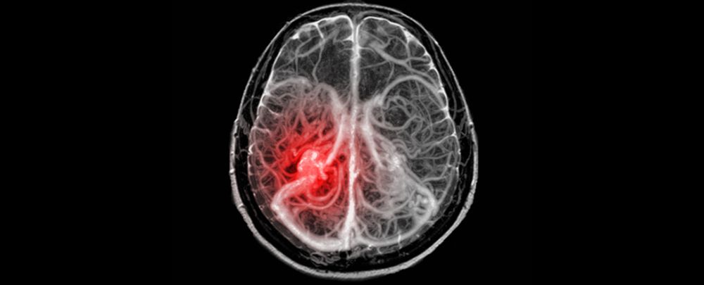 Air Pollution Linked With Increased Risk of Brain Bleeds in US Study