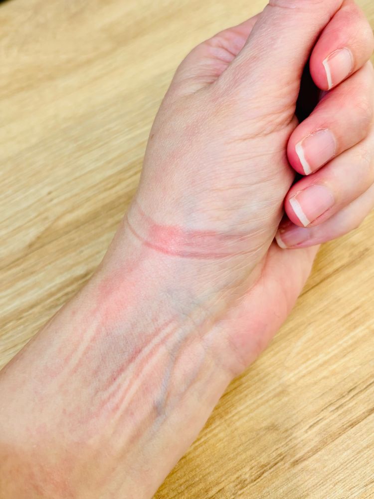 Photo de ma main avec des marques rouges et blanches. 