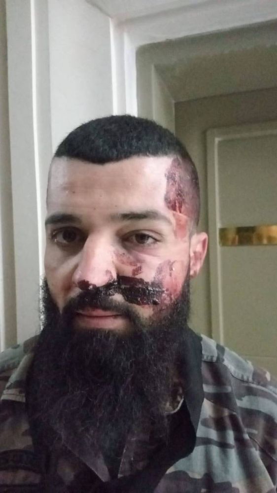 A Palestinian man with a short haircut and a long black beard stands indoors against a cream-coloured wall. His face is covered in visible injuries: large abrasions and raw, bloody patches across his cheek, nose, and forehead. Dried blood and damaged skin extend across his left cheek and upper lip. He looks directly at the camera with a subdued, exhausted expression. He is wearing a camouflage-patterned shirt.