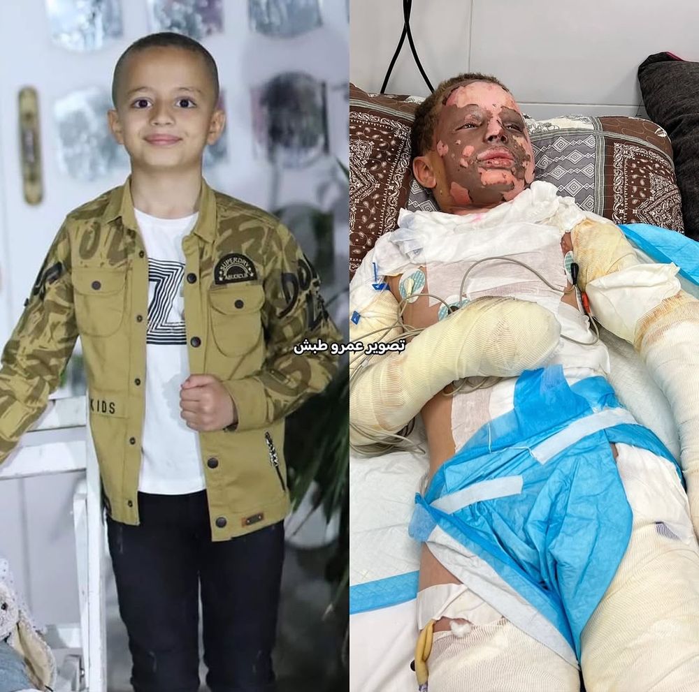 Side-by-side photos show a young Palestinian boy before and after suffering severe injuries. On the left, Majd Abu Habib, around 11 years old, smiles gently while standing indoors wearing a tan jacket and white shirt. On the right, he lies in a hospital bed with his body covered in medical bandages, IV lines, and burn dressings. His face and arms are visibly scarred and wrapped, reflecting the extent of his critical burn injuries.