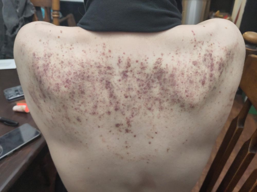Vx's bruised back, the day after 