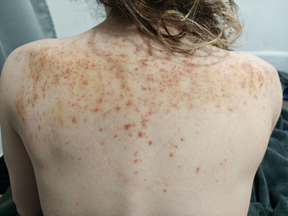 Vx's bruised back, a few days after 