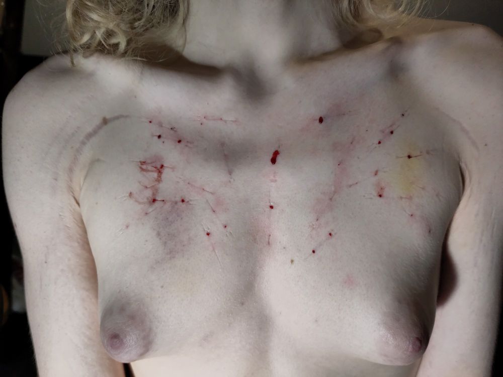 Bloody post needling.
