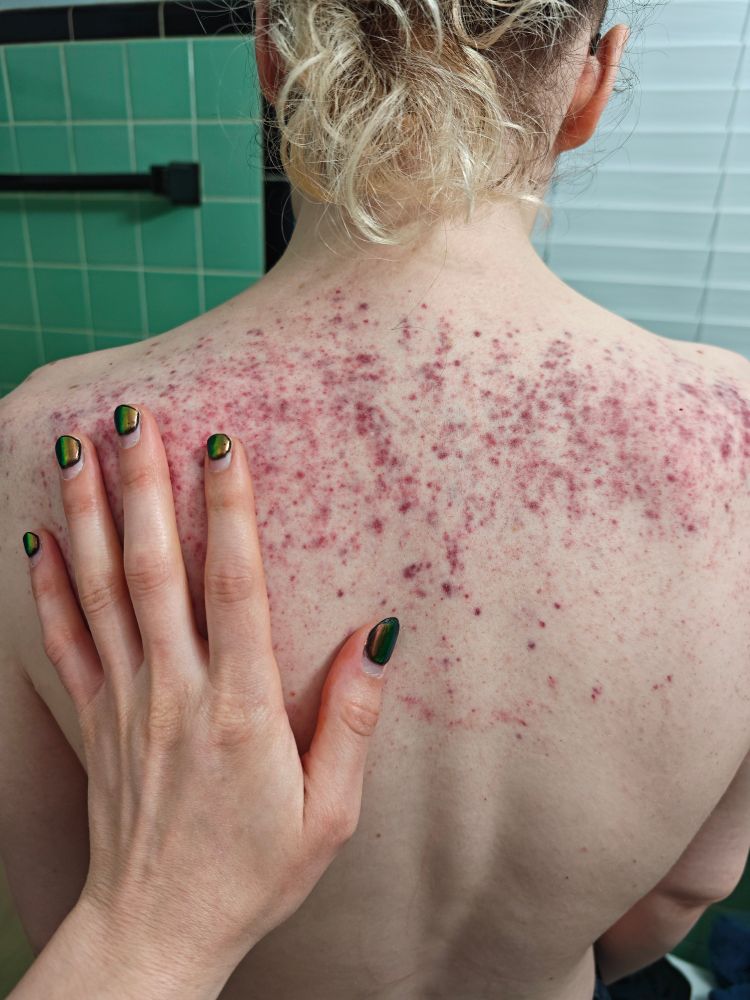 Vx's back, broken capillaries and bruised, the night of the beating 