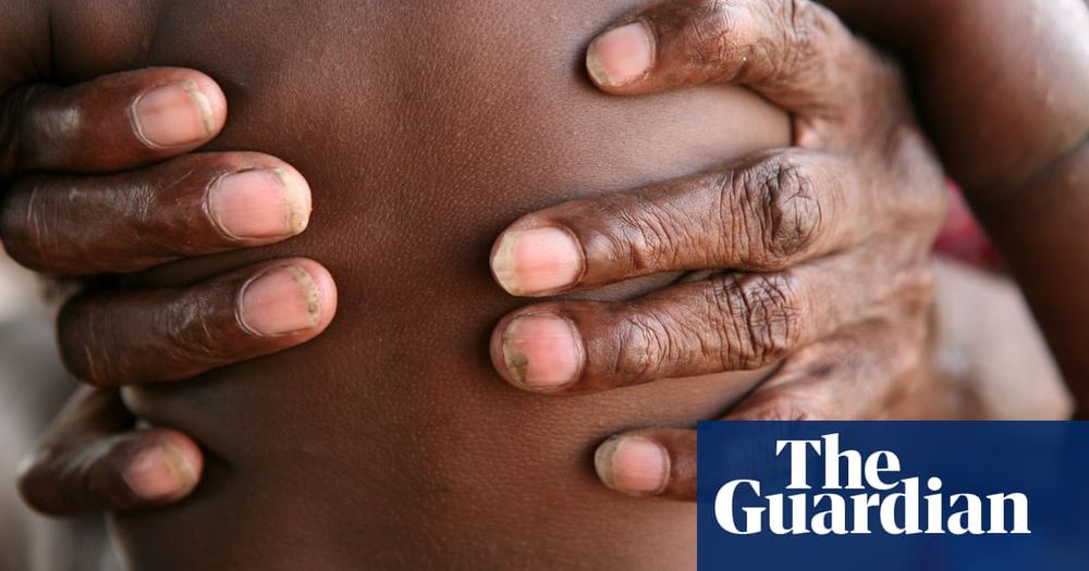 Skin checks helped reduce infections in Aboriginal children by half, study finds