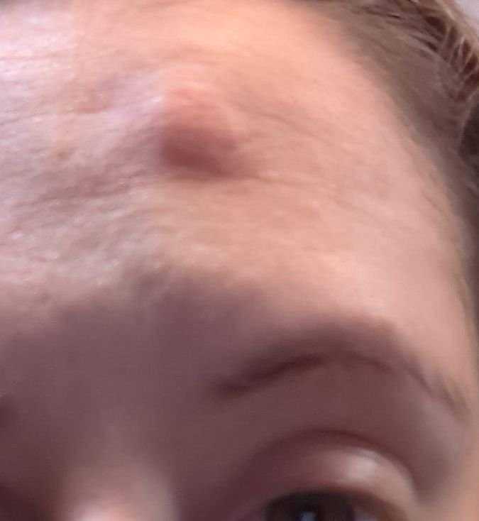 close up selfie showcasing the huge red lump on her forehead.