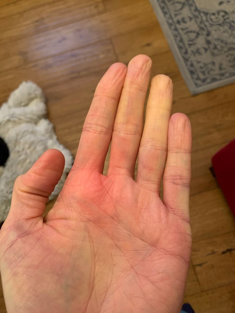 Left hand showing starting signs of Raynauds