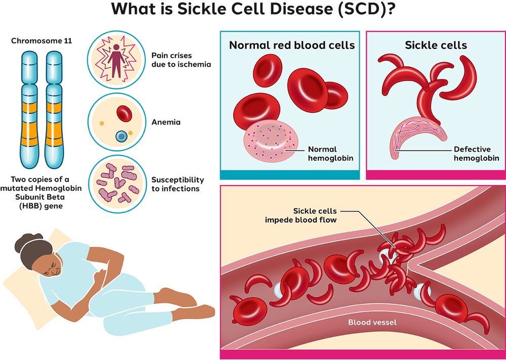 What is Sickle Cell Disease (SCD)?