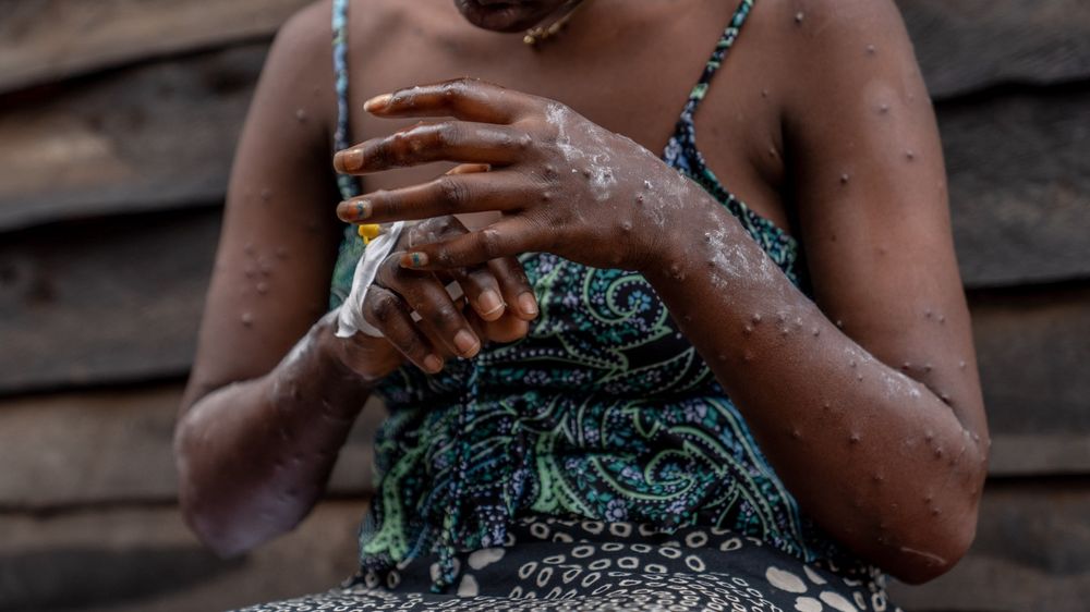 A year ago, on August 14, 2024, the World Health Organization declared mpox a Public Health Emergency of International Concern. Why are health experts so frustrated by the world's response?