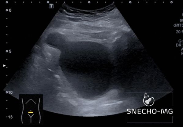 Coupe échographique transverse du bas abdomen, image de vessie.
En haut à gauche de l’image, on peut observer le diverticule. Nous sommes sur une coupe transverse, le diverticule est donc situé sur la paroi supérieure droite de la vessie du patient.
Le diverticule vésical est secondaire à une « hernie » de la muqueuse vésicale qui s’insinue entre les fibres musculaires lisses de la paroi de la vessie. Il ne présente donc pas de paroi musculaire, sa muqueuse est ainsi en contact direct avec la graisse péri vésicale.