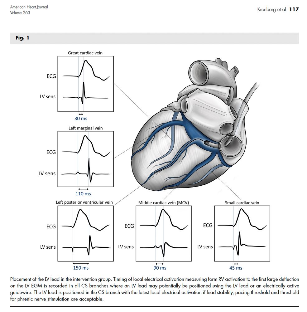 Fig. 1. Placement of the LV lead in the intervention group. Timing of local electrical activation measuring form RV activation to the first large deflection on the LV EGM is recorded in all CS branches where an LV lead may potentially be positioned using the LV lead or an electrically active guidewire. The LV lead is positioned in the CS branch with the latest local electrical activation if lead stability, pacing threshold and threshold for phrenic nerve stimulation are acceptable.