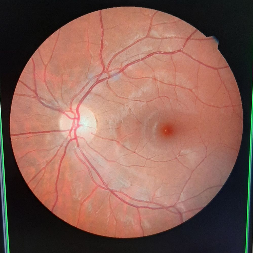 A photo of my retina. The photo is a circle and pink with a blue undertone. There are darker pink lines indicating blood vessels. Unfortunately, I do not know enough about the anatomy of an eye to correctly describe the components!
