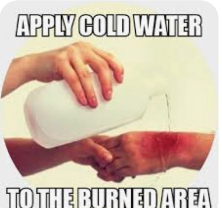 A picture of someone gently pouring water over a burn on another person's hand. Text reads, "Apply cold water to the burned area". 