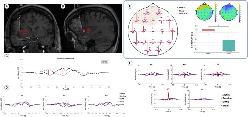 An image showing the key results of the paper, including post-implantation reconstructed 3D T1w imaging of the insular electrode seen in the coronal plane and heart-evoked potentials per condition.