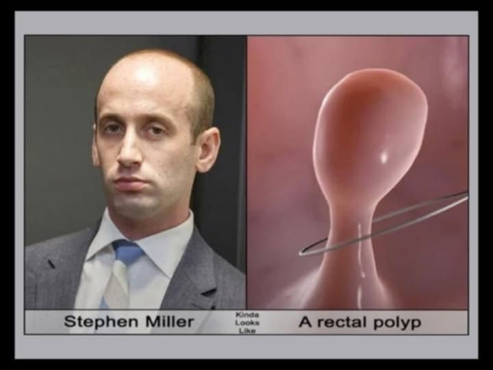 a side by side of stephen miller and a rectal polyp