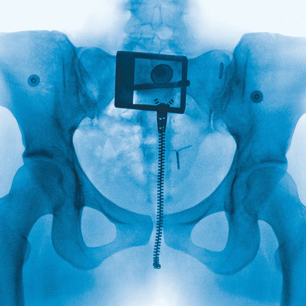 Lorde Virgin Album Cover, blue pelvic x-ray